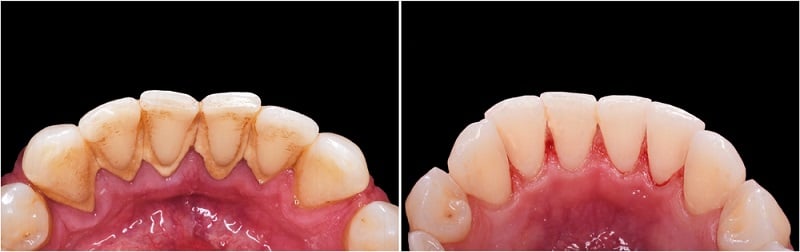 Gum Disease Treatment Illustration