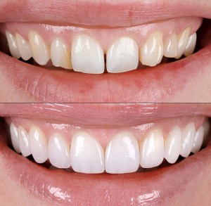 Porcelain Veneers Illustration